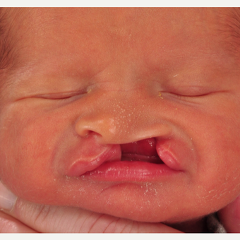 17 or under year old man treated with Cleft Lip And Palate Repair before 3639057