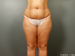 Tummy Tuck before 1384840