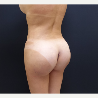 35-44 year old woman treated with Brazilian Butt Lift Revision after 3234467