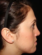 Nose Surgery after 1467002