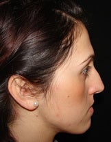 Nose Surgery before 1467002
