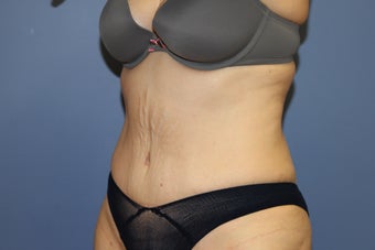 53 year-old woman with previous C section scar treated with abdominoplasty 1516260