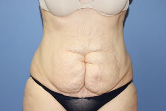 53 year-old woman with previous C section scar treated with abdominoplasty before 1516260