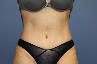 53 year-old woman with previous C section scar treated with abdominoplasty after 1516260