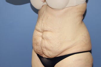 53 year-old woman with previous C section scar treated with abdominoplasty 1516260