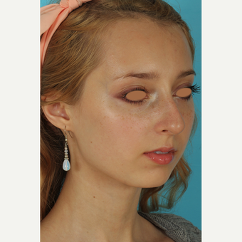 25-34 year old woman treated with Rhinoplasty before 3628963
