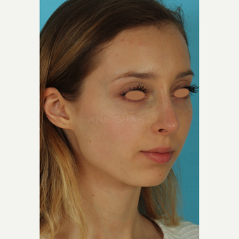 25-34 year old woman treated with Rhinoplasty after 3628963