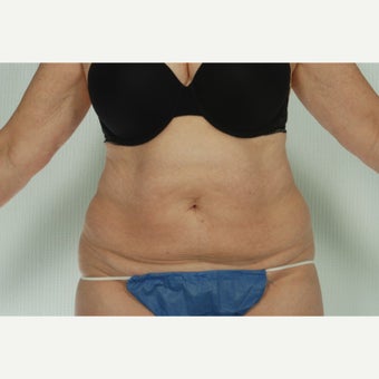 41 year old woman treated with CoolSculpting after 1661692