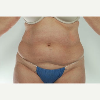 41 year old woman treated with CoolSculpting before 1661692