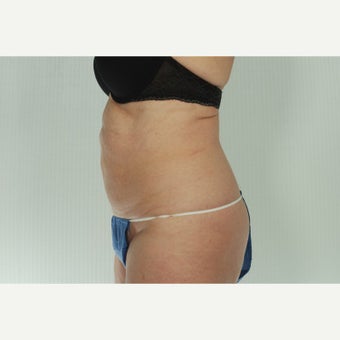 41 year old woman treated with CoolSculpting 1661692