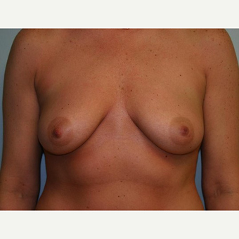 Breast Augmentation before 3560718