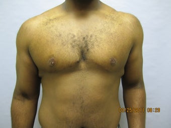 34 y.o man with breast reduction after 1005234