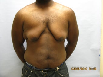 34 y.o man with breast reduction before 1005234