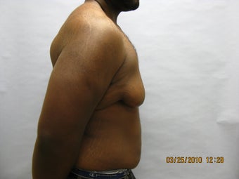 34 y.o man with breast reduction 1005234