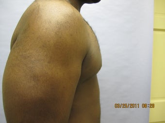 34 y.o man with breast reduction 1005234