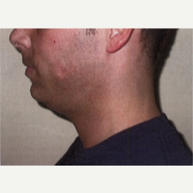 25-34 year old man treated with Chin Implant before 3065752