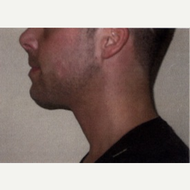 25-34 year old man treated with Chin Implant after 3065752