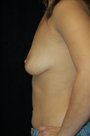 Breast Augmentation, gel implants 392059