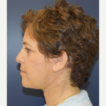 55-64 year old woman treated with Facelift after 3460942