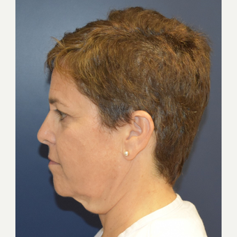 55-64 year old woman treated with Facelift before 3460942