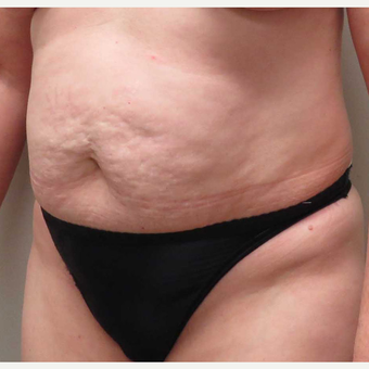 Tummy Tuck for this 51 Year Old Woman before 3043094