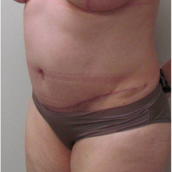 Tummy Tuck for this 51 Year Old Woman after 3043094
