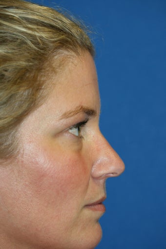 Lower Blepharoplasty and Fat Transfer before 1023416