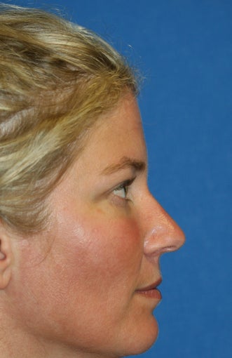 Lower Blepharoplasty and Fat Transfer after 1023416