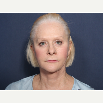 65-74 year old woman treated with Neck Lift (view 1 of 2) after 3259223
