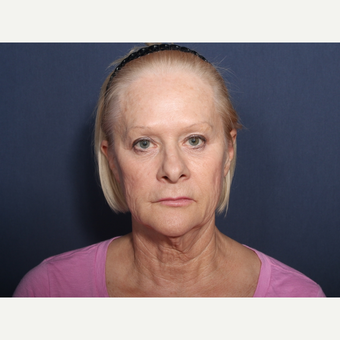 65-74 year old woman treated with Neck Lift (view 1 of 2) before 3259223