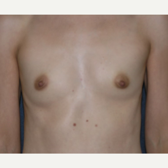35-44 year old woman treated with Breast Augmentation before 3455295