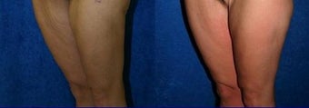 Thigh Lift after massive weight loss before 667184