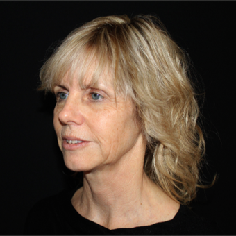 55-64 year old woman treated with Facelift before 3498824