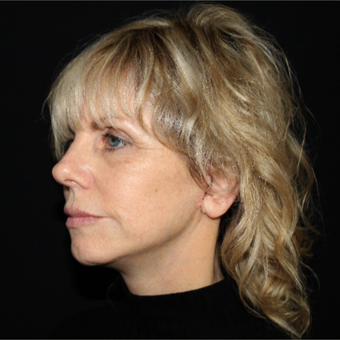 55-64 year old woman treated with Facelift after 3498824