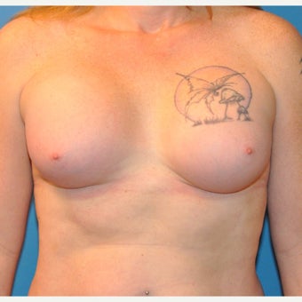 Transgender (male to female) Breast Augmentation after 2420982