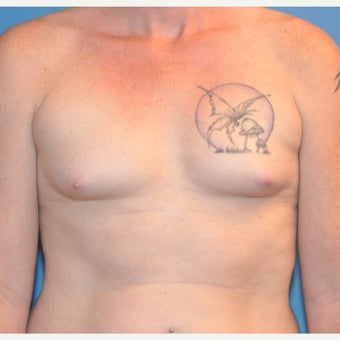 Transgender (male to female) Breast Augmentation before 2420982