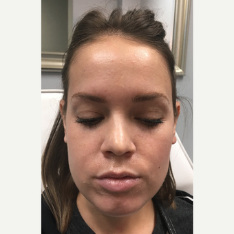 18-24 year old woman treated with Juvederm Volbella before 3769925