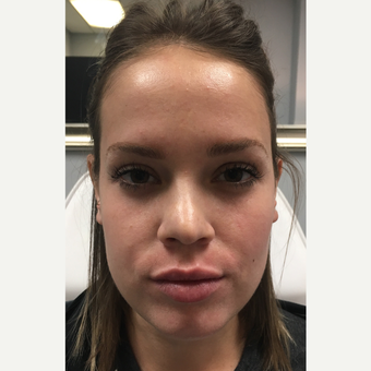 18-24 year old woman treated with Juvederm Volbella after 3769925