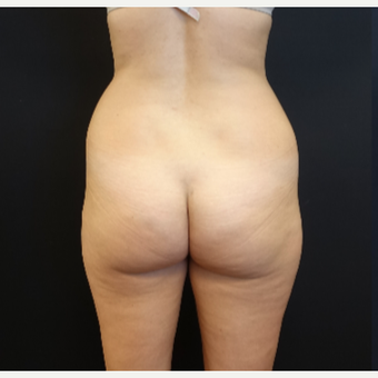 25-34 year old woman treated with Liposculpture before 3629873
