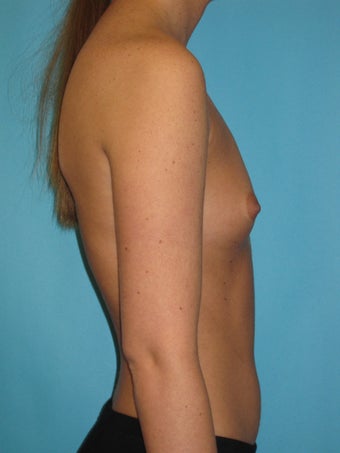 Natural Looking Breast Implants to Suit Your Body 1321475