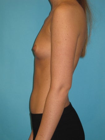 Natural Looking Breast Implants to Suit Your Body before 1321475
