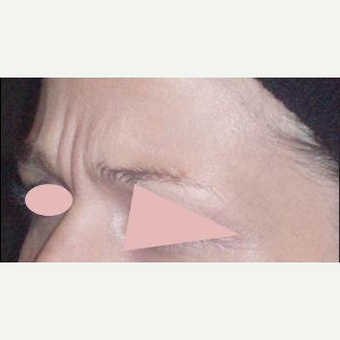 25-34 year old woman treated with Botox before 3162524