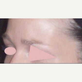 25-34 year old woman treated with Botox after 3162524