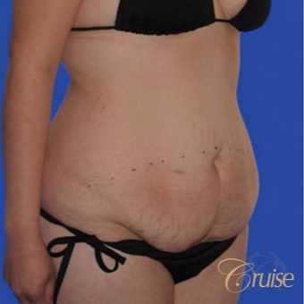 24 year old female had a Standard Tummy Tuck before 3584938