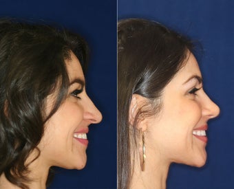 Nose Surgery before 1430618