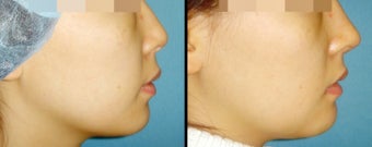 Rhinoplasty before 962057