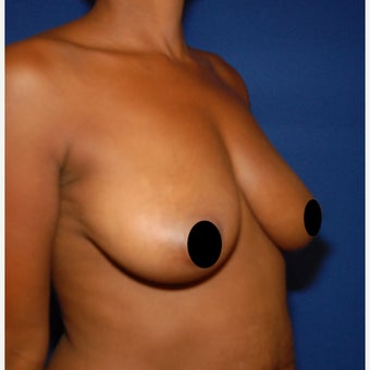 45-54 year old woman treated with Breast Fat Transfer before 2427807
