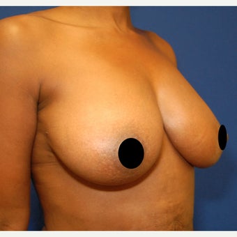 45-54 year old woman treated with Breast Fat Transfer after 2427807