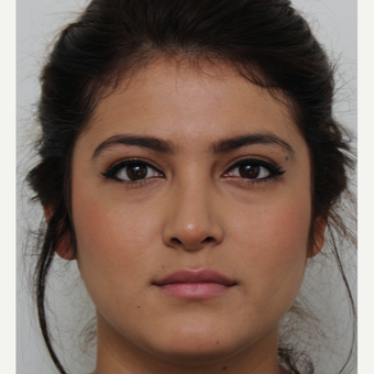 18-24 year old woman treated with Revision Rhinoplasty after 3582928
