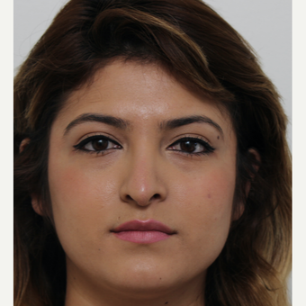 18-24 year old woman treated with Revision Rhinoplasty before 3582928